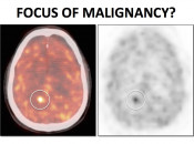 Figure 3 (Image 3) PET/CT Scan