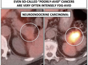 Figure 2 (Image 3) neuroendocrine carcinoma