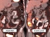 Figure 5 (Image 3) poor patient prep