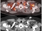 Figure 1 (Image 3) brown fat case 1