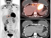 Figure 2 (Image 3) brown fat case 2