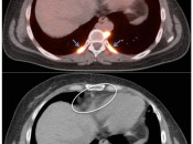 Figure 4 (Image 3) brown fat case 4