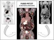 The tremendous power of PET/CT is dramatically illustrated when we fuse the “anatomic” CT images with the “functional” PET images, revealing an elegant map of all active disease. PET-Scan-fig-1-img-3