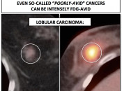 Figure 2 (Image 4) lobular carcinoma