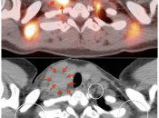 Figure 3 (Image 4) brown fat case 3