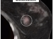Figure 1 (Image 4) lobular carcinoma