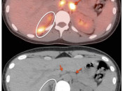 Figure 3 (Image 5) brown fat case 3