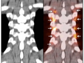 Figure 1 (Image 5) brown fat case 1