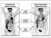 Figure 1 (Image 1) PET/CT Scan